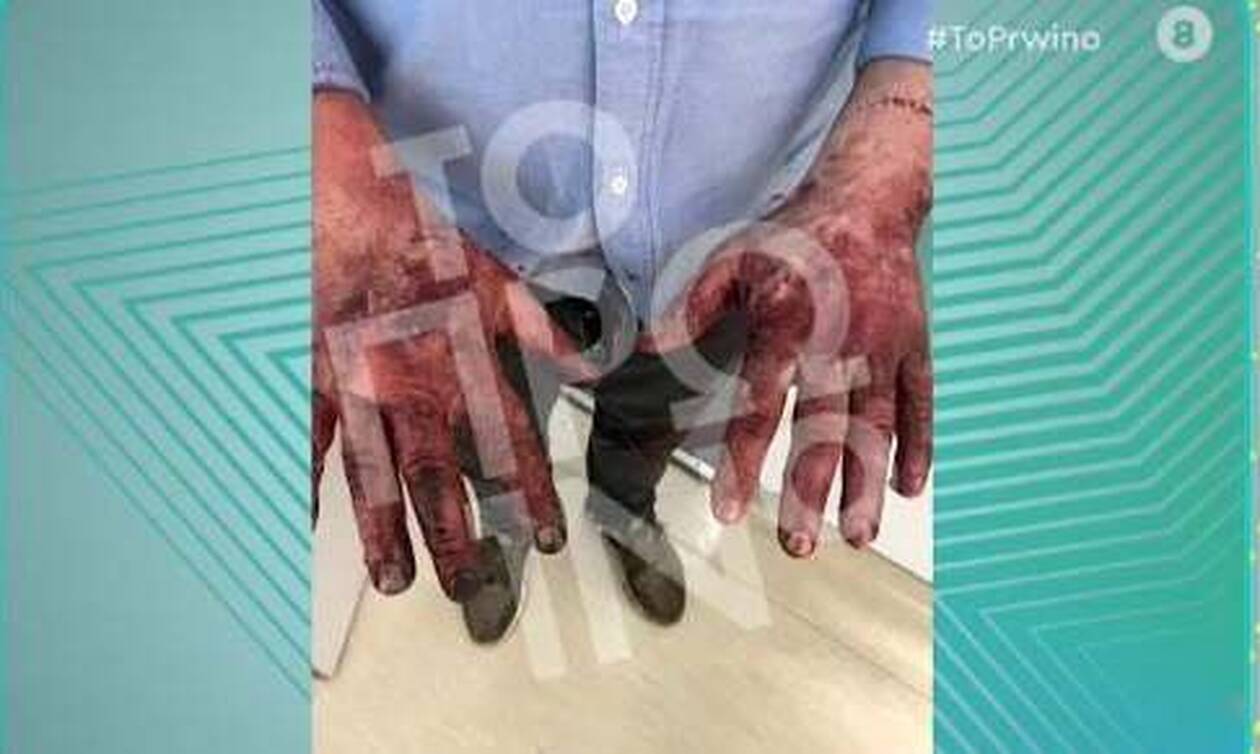 Όπως ανέφερε ο Γιώργος Λιάγκας, ο Τζώρτζης Μονογυιός παρέλαβε το supercar από τη Βούλα μαζί με τον κολλητό του φίλο, ο οποίος τον ακολουθούσε στο σπίτι του επιχειρηματία στη Βουλιαγμένη για να βάλουν το αυτοκίνητο στο πάρκινγκ. Ο φίλος του βρισκόταν τρία αυτοκίνητα πίσω από τη Ferrari και είδε μπροστά στα μάτια του το φρικτό τροχαίο. Ο ίδιος ήταν αυτός που έτρεξε πρώτος και άνοιξε την πόρτα του συνοδηγού της φλεγόμενης Ferrari και απεγκλώβισε την σύζυγο του επιχειρηματία Αθηνά Κοντοπάνου και στη συνέχεια τον Τζώρτζη Μονογυιό ο οποίος ήταν ήδη νεκρός. Η εκπομπή «Πρωινό» παρουσίασε φωτογραφίες από τα εγκαύματα του κολλητού φίλου του Τζώρτζη Μονογυιού, οι οποίες συγκλονίζουν.